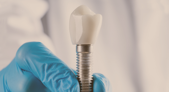 Dental Implants
