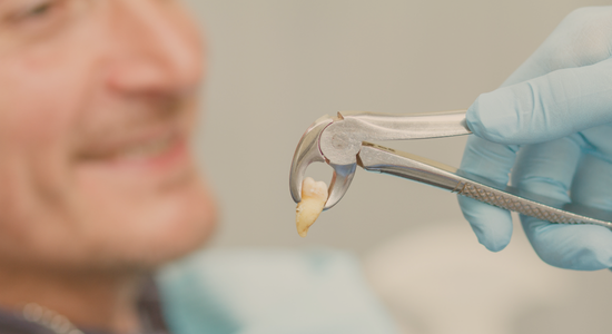 Tooth Extraction